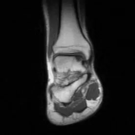 Ayak bileği coronal MR T1