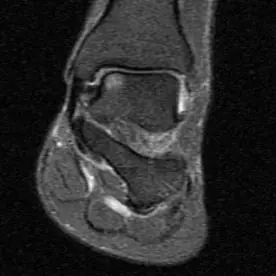 Ayak bileği coronal MR T2