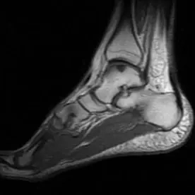 Ayak bileği sagittal MR T1