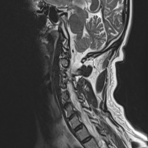 C4-C5 seviyesindeki kanala taşmış ve omuriliğe bası yapmış fıtığın sagital görüntüsü.