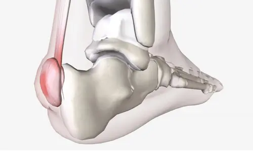 Haglund Deformitesi Nedir? Tanısı ve Tedavisi