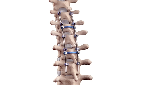 İpli Skolyoz Ameliyatı Nedir? Kimlere Uygulanır?