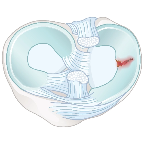 Radial (Radyal) Menisküs Yırtığı