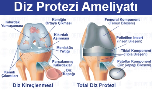 Diz Protezi Ameliyatı Nedir? Nasıl Yapılır? Fiyatı 2025?