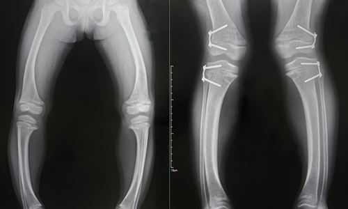 Epifizyodez Nedir? Ameliyatı Nasıl Uygulanır?
