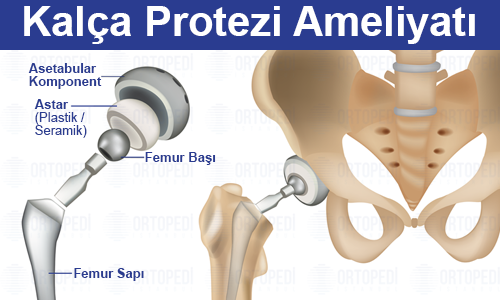 Kalça Protezi Ameliyatı Nedir? Nasıl Yapılır?