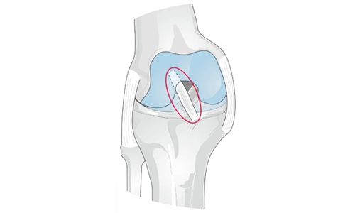 Menisküs Nakli Nedir? Nasıl Yapılır? Fiyatı?