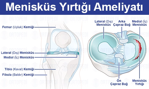 Menisküs Yırtığı Ameliyatı Nedir? Nasıl Yapılır?