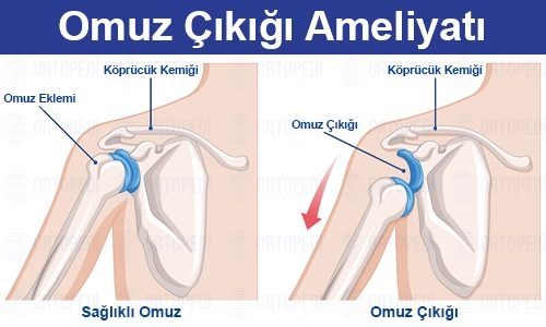 Omuz Çıkığı Nedir? Tedavisi ve Ameliyatı