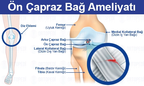 Ön Çapraz Bağ Ameliyatı Nedir? Ameliyat Sonrası? Fiyatı?