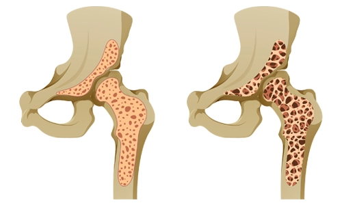 Osteomalazi (Kemik Yumuşaması) Belirtileri ve Tedavisi