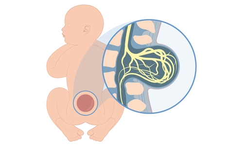 Spina Bifida (Açık / Ayırık Omurga Hastalığı)