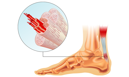 Tendon Uzatma Ameliyatı Nedir? Neden Yapılır?