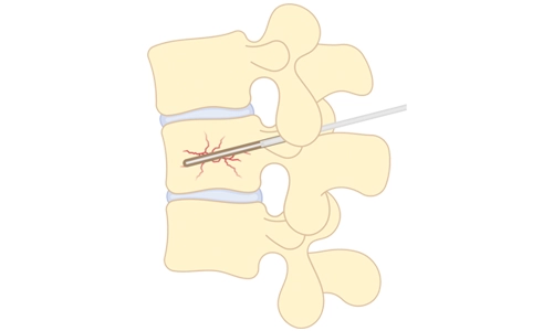 Vertebroplasti Nedir? Vertebroplasti Kimlere Uygulanır?