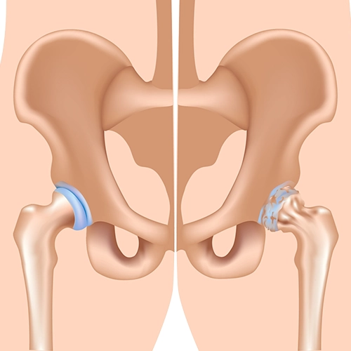 Kalça eklem kireçlenmesi.