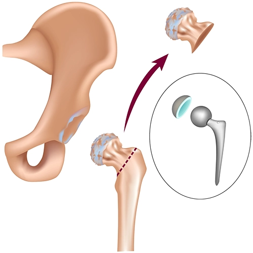 Femur başının çıkarılması.