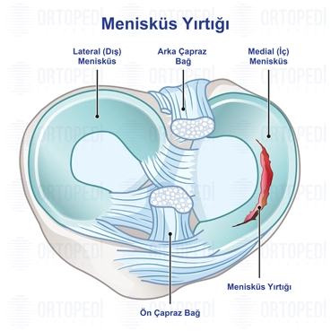 Menisküs Yırtığı Ameliyatı