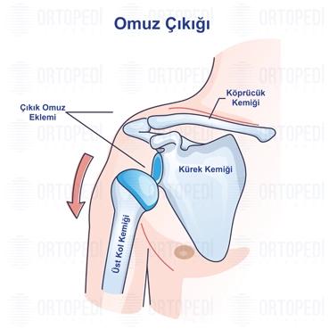 Omuz Çıkığı