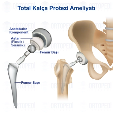 Kalça Protezi Ameliyatı